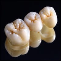 Multiple dental crowns in Sydney.