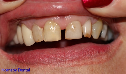Patient patient presents with old anterior veneers that have been breaking down and unaesthetic proportions.