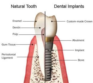 Dental Implants in Sydney